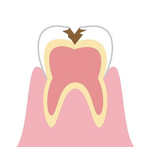 中度の虫歯治療（象牙質にまで進行した虫歯）