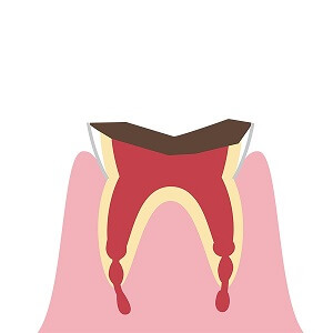 重度の虫歯（歯の根にまで進行した虫歯）