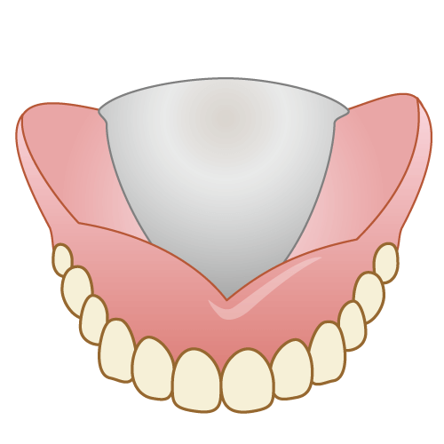 金属床義歯（総入れ歯）