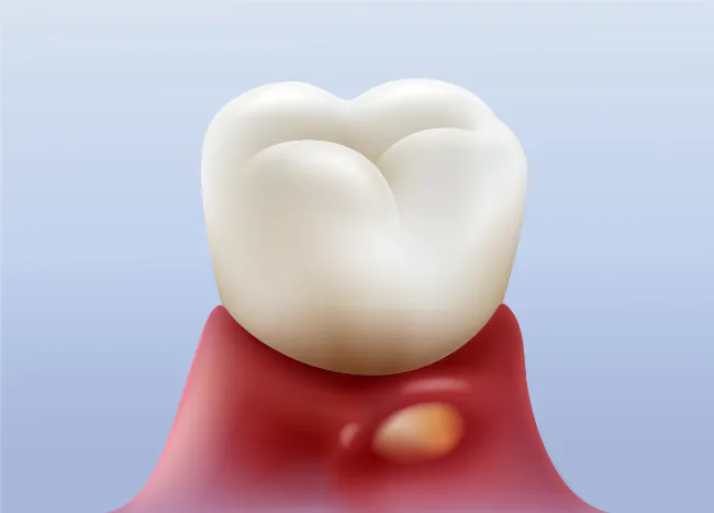 歯茎の炎症