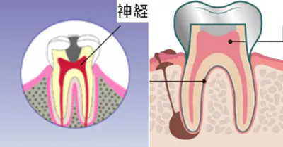 根管治療（根の治療）では前歯と小臼歯の抜髄（最初の根管治療、感染した部分が上部だけに限られる場合の根管治療）のみとします（成功率約60％）