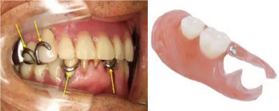 入れ歯は金属を使う義歯も可能とします